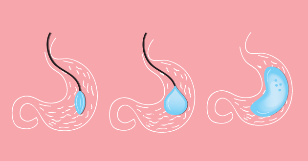 Intragastric balloon weight loss procedure Intragastric balloon weight loss procedure