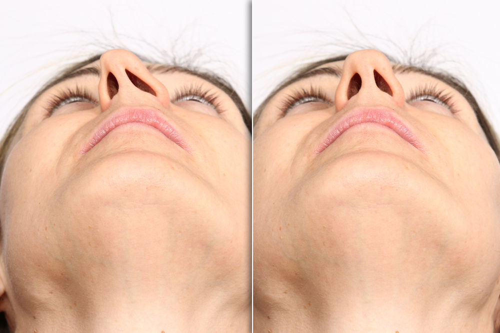 deviated septum deviated septum