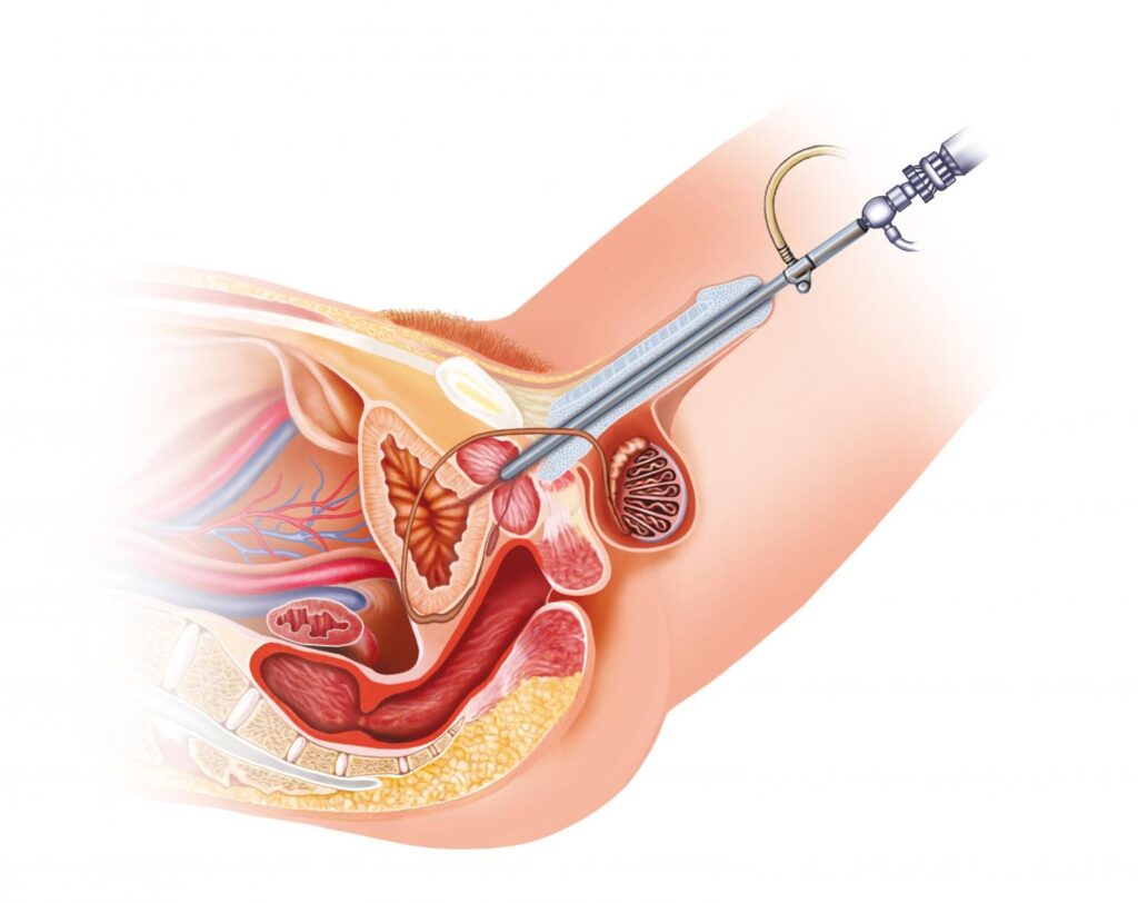 Bladder cancer surgery Bladder cancer surgery