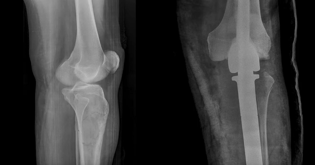 tumor tibije